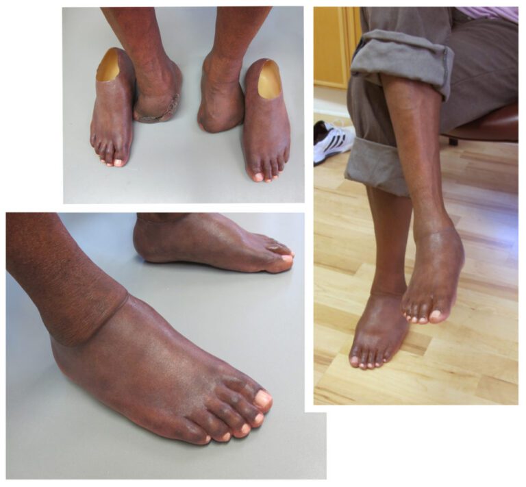 Feet Archives - Aesthetic Prosthetics Inc®