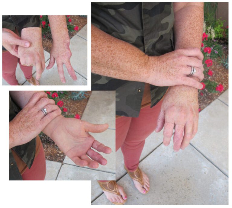 Feet Archives - Aesthetic Prosthetics Inc®