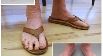 Wearing Sandals Again? No Problem
