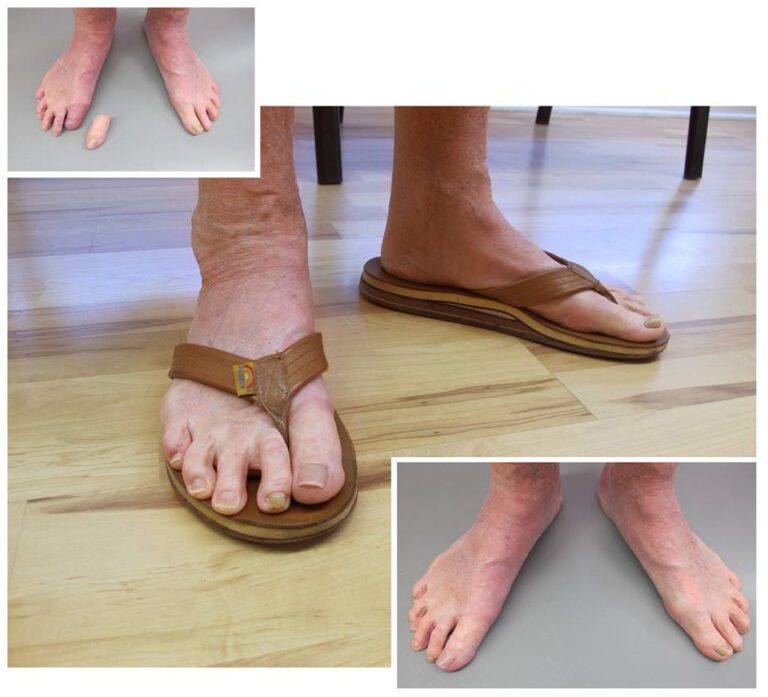 Wearing Sandals Again? No Problem