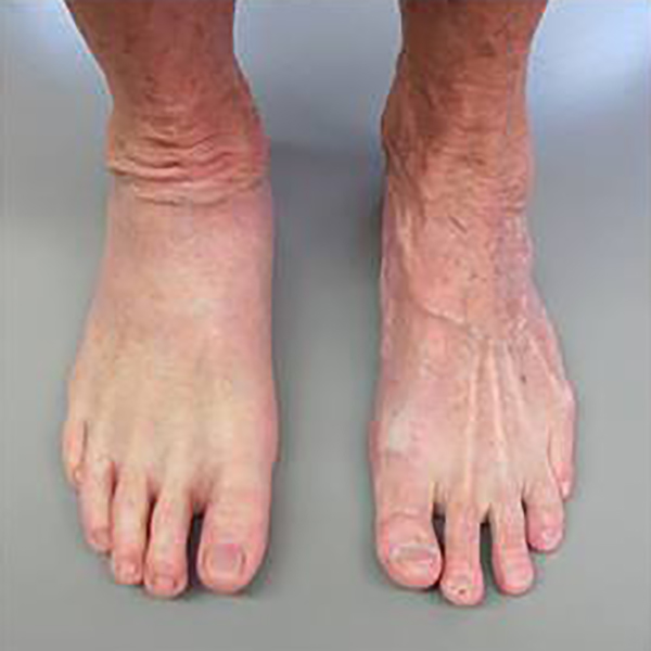 Feet Archives - Aesthetic Prosthetics Inc®